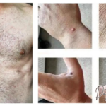 30-prozentigen Anstieg der Affenpockenfälle