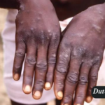 Ein Patient mit Mpox im Jahr 1997 in der Demokratischen Republik Kongo