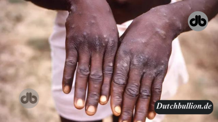 Ein Patient mit Mpox im Jahr 1997 in der Demokratischen Republik Kongo