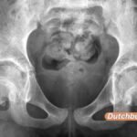 Was Schwangerschaft und Geburt mit dem Körper eines jungen Mädchens machen